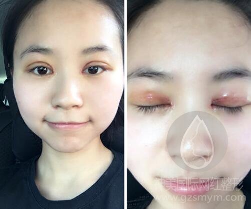 广州双眼皮全切价格,眼综合哪家