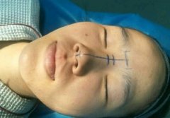 隆鼻价格多少钱,广州鼻综合哪里