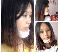 广州双眼皮鼻综合哪家医院好